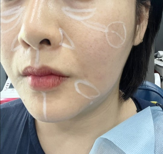 AestheFill o que é? 5 Fatos Importantes Sobre Este Filler